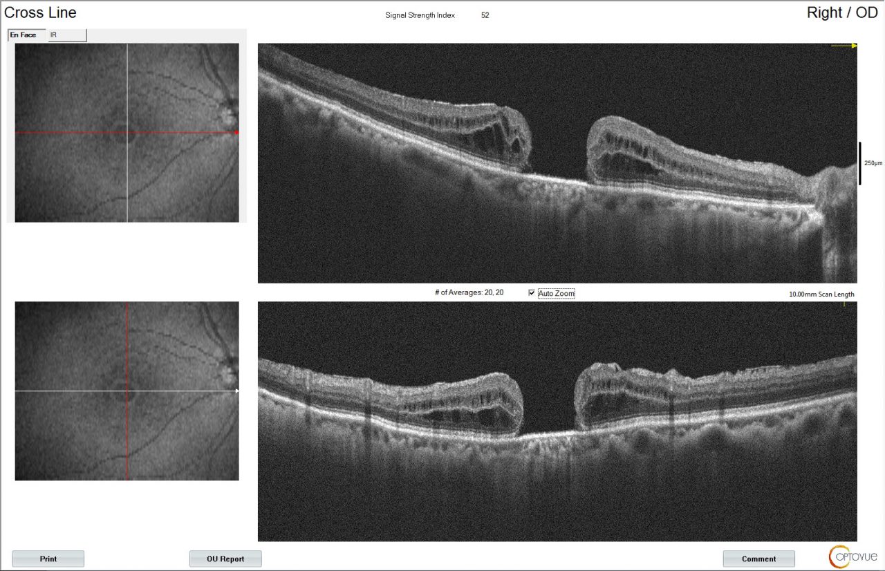 Agujero macular Oftalmologos Consultores